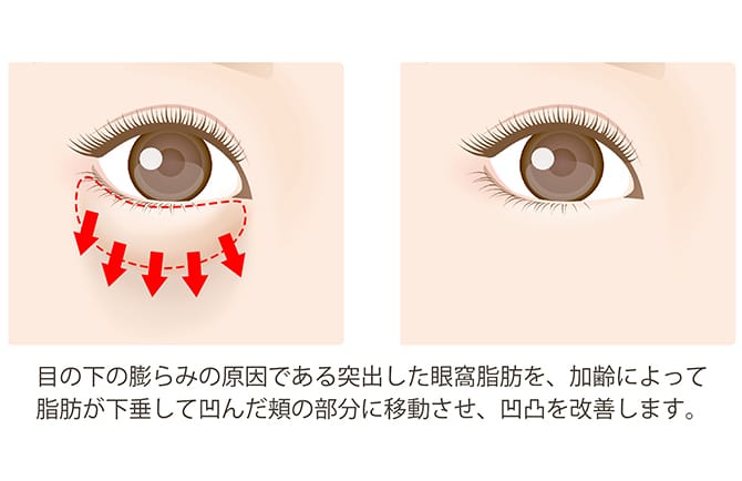 ハムラ法・裏ハムラ法による改善