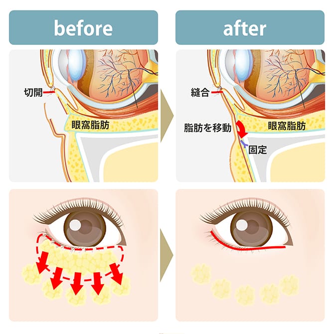 ハムラ法の施術前後