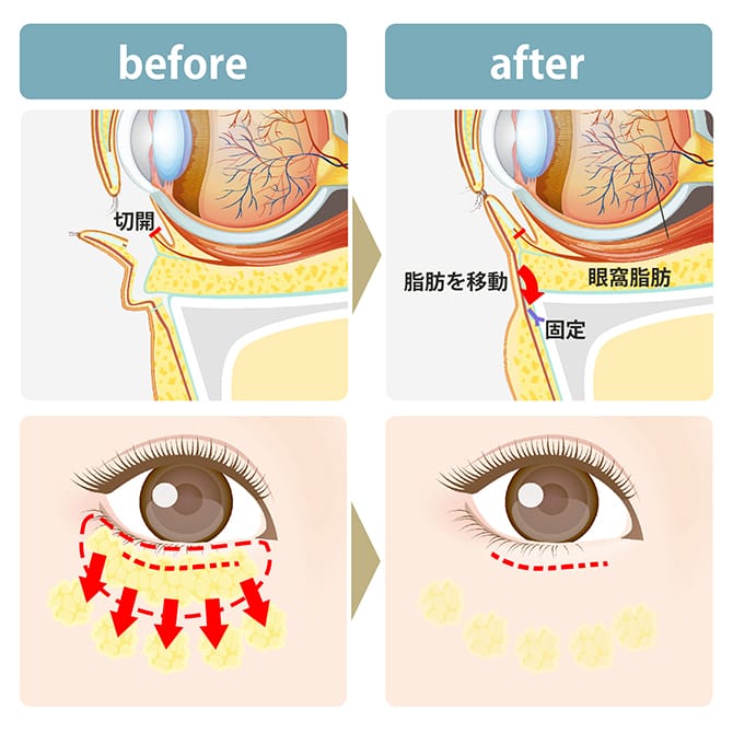 裏ハムラ法の施術前後