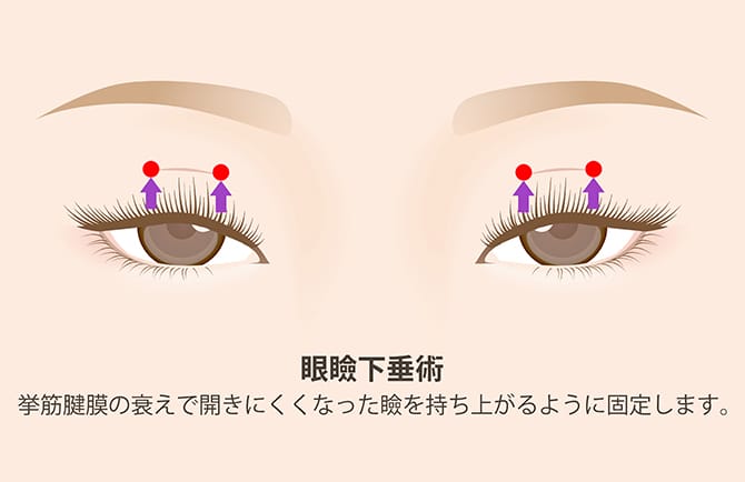 眼瞼下垂術の図