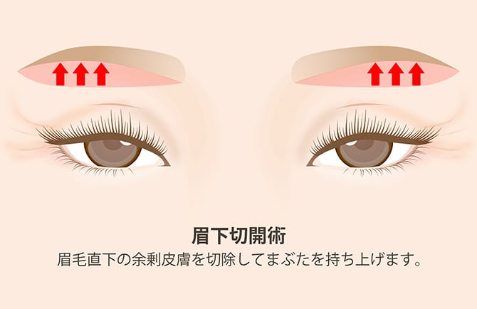 眉下切開術の図