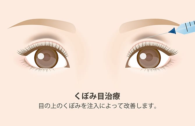 くぼみ目の注入治療の図