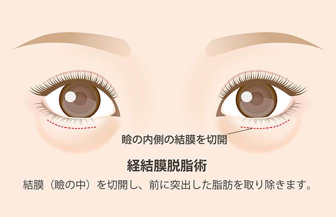 脂肪取り術の図