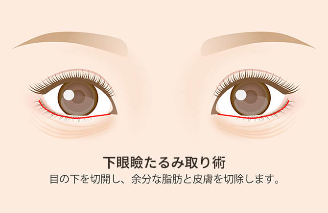 目の下たるみ取り術の図
