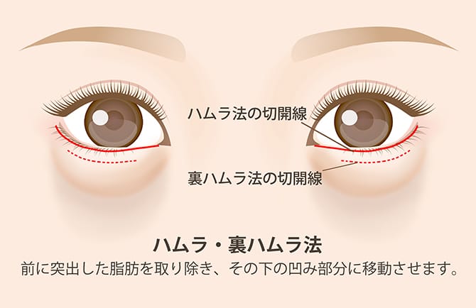 ハムラ法・裏ハムラ法の図