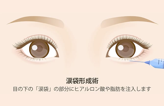 涙袋形成術の図