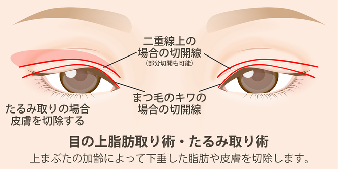目の上たるみ取り術・脂肪取り術の図