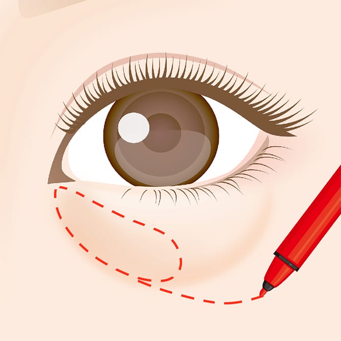 脂肪取り術のマーキング