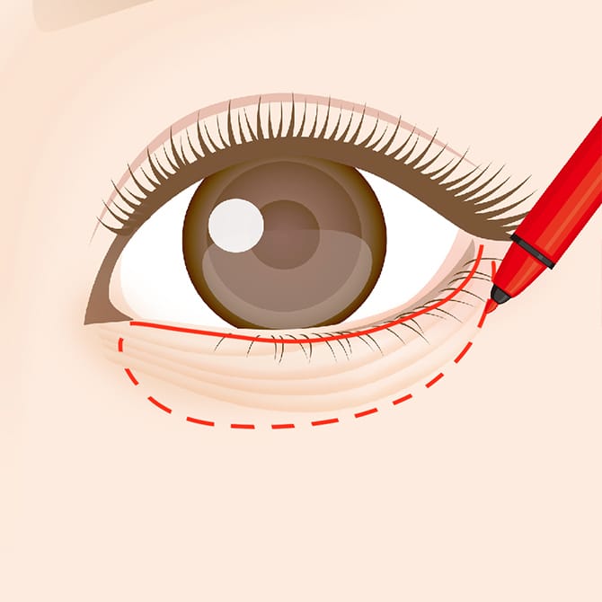 下まぶたのマーキング