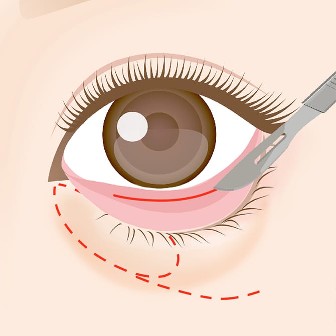 下まぶたの内側の切開