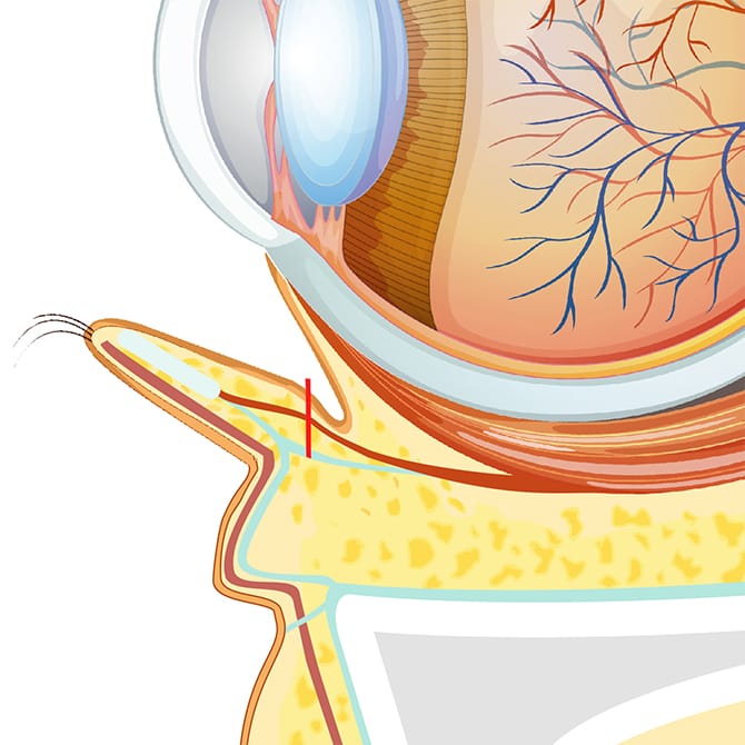 下まぶたの内側の切開