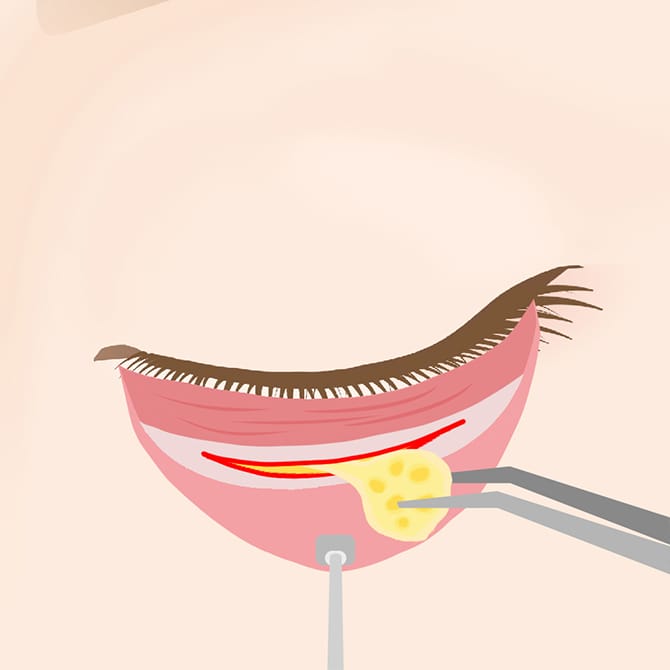 眼窩内脂肪の除去