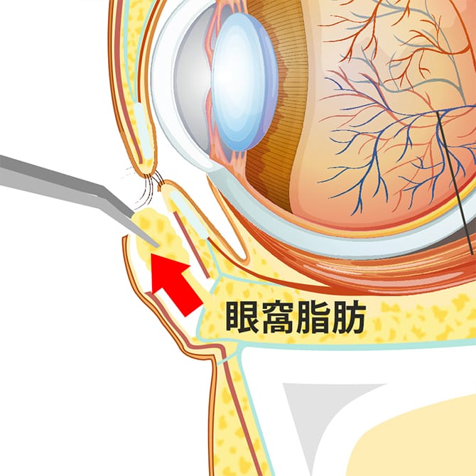眼窩内脂肪の除去