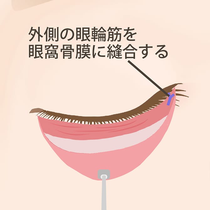 外側の眼輪筋を眼窩骨膜に縫合する