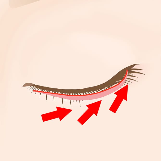 外側の眼輪筋を眼窩骨膜に縫合する