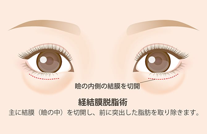 目の下脂肪取り術