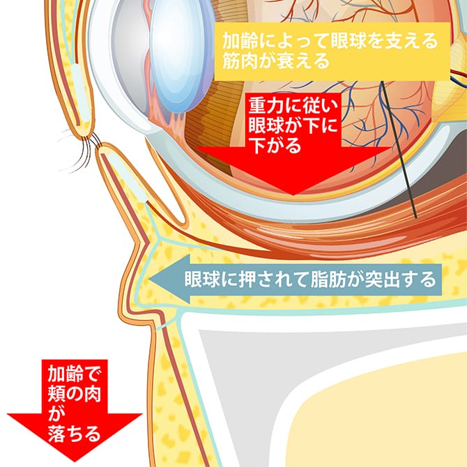 下まぶたのたるみ、脂肪が出てくる原因