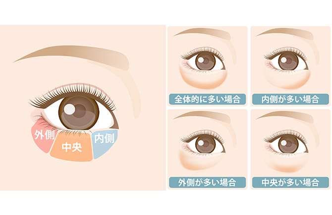 脂肪は内側、中央、外側の3つのコンパートメントに分かれて存在