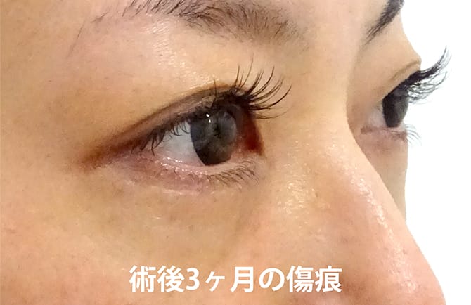 術後3ヵ月の傷痕の写真