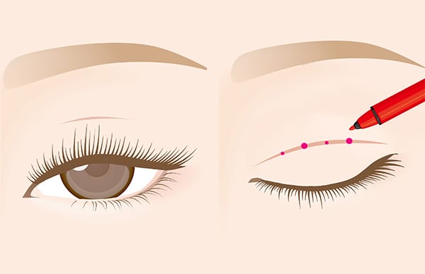まぶたにマーキング