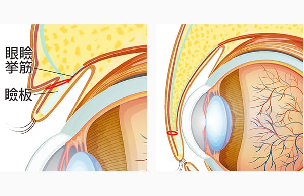 眼瞼挙筋、瞼板