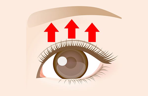 挙筋短縮埋没法の施術完了
