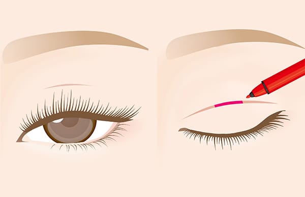 まぶたにマーキング