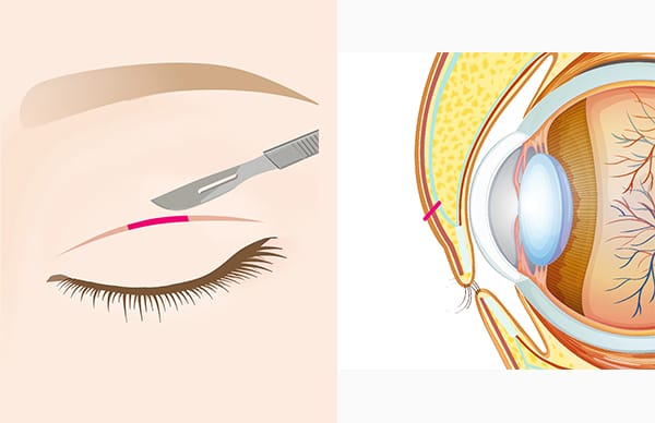 まぶたを切開