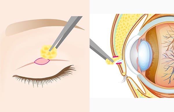 眼窩脂肪を除去