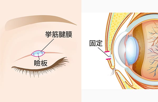 挙筋腱膜を瞼板に固定