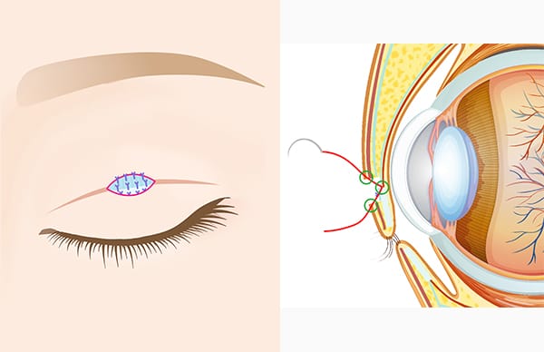皮下組織と挙筋腱膜の断端を縫合固定