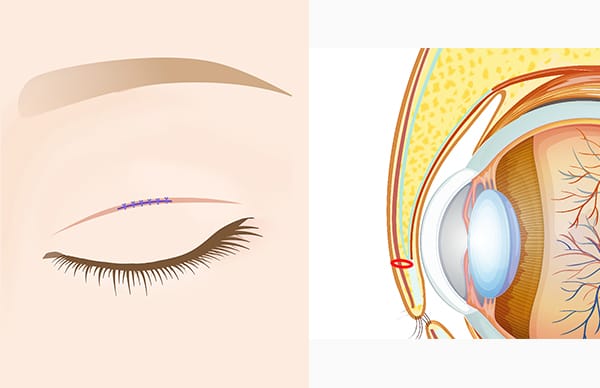 まぶたの切開部の縫合