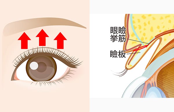 挙筋短縮部分切開法の施術完了