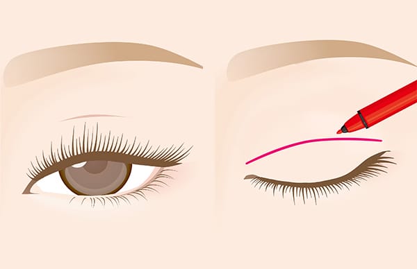 まぶたにマーキング