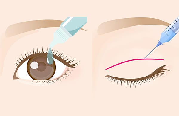 点眼麻酔、局所麻酔