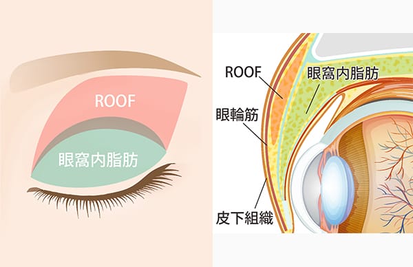 眼窩内脂肪とROOF