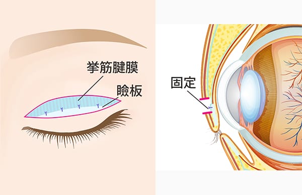 挙筋腱膜を瞼板に固定