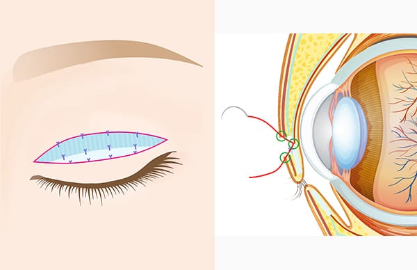 皮膚と挙筋腱膜の断端を縫合