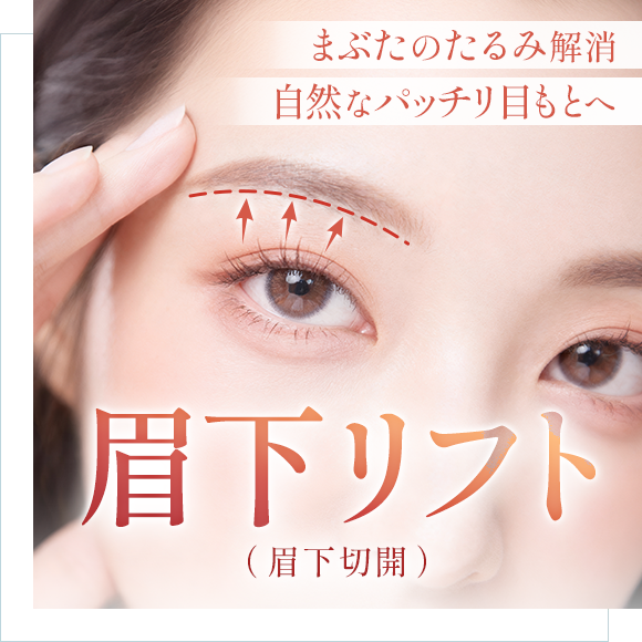眉下リフト(眉下切開)