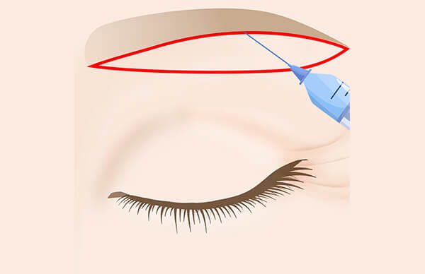 眉下に局所麻酔