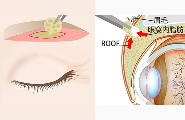 眼窩内脂肪とROOFを切除