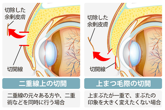 目もとの印象によって切開線を選択可