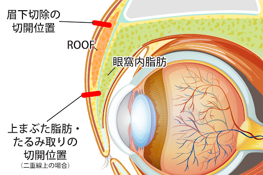 眉下切開術