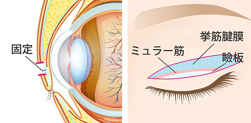 二重整形や眼瞼下垂術を同時に行う場合