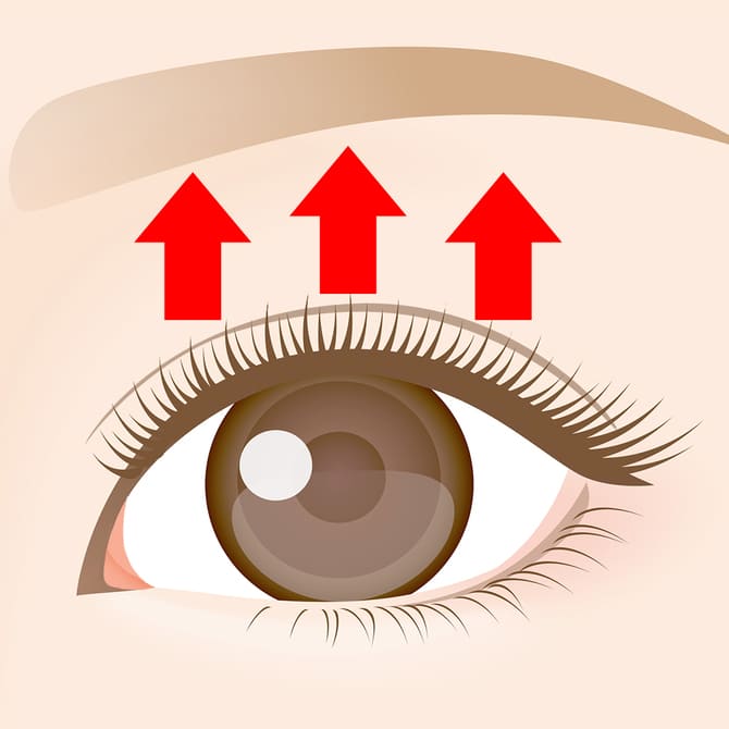 目の上たるみ取り術・脂肪取り術の完成図