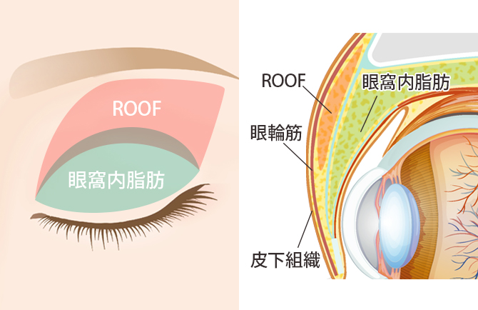 眼窩内脂肪とROOFの図