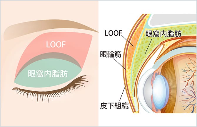 眼窩内脂肪とROOFの図