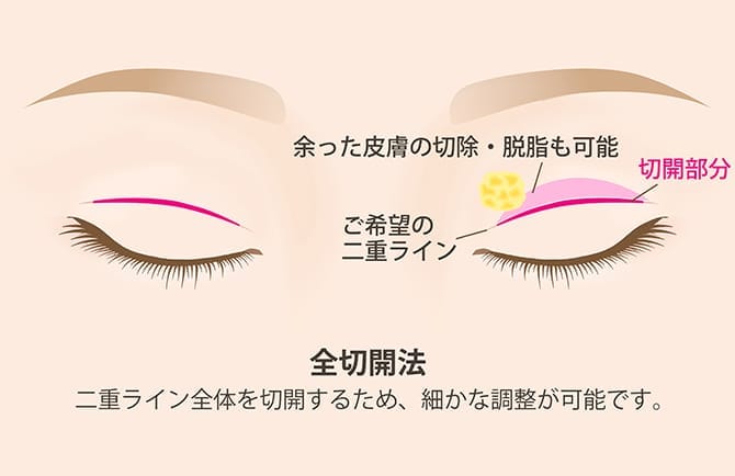 全切開法
