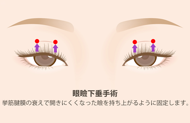 眼瞼下垂手術