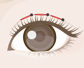 二重埋没法1点～3点留めのイメージ